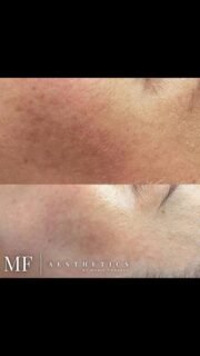 If you’ve been let down by treatments that didn’t deliver results for your melasma, I want you to know you’re not alone. Trusting the wrong person can sometimes make things worse, but finding the right expert makes all the difference. 
I’m truly grateful to this client for trusting me with her skin journey. She committed to a series of three Green Sea Peels, which, along with her regular quarterly maintenance visits, helps us keep her melasma under control. Plus, she’s dedicated to using the right skincare products at home to support her progress.
Patience, consistency, and expertise are key I’m here to guide you every step of the way. Your skin’s health and confidence are worth it! 💙✨#selfcare #melasma #chicagomelasmatreatment #loveyourskin #melasmaremoval #melasmacontrol #koreanskincare