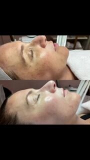 ✨ Say goodbye to melasma and hypopigmentation! ✨ 
We’ve just completed a series of Green Sea Peels, and I couldn’t be happier with the amazing results we’ve seen. This treatment helps even out skin tone, brighten your complexion, and restore your confidence. 
If you’re struggling with melasma or uneven pigmentation, now is the perfect season to start your journey to radiant, flawless skin. Don’t wait—your glow-up is ahead! 🌿💫 
Book your consultation today and let’s work together to reveal your best skin. 
#MelasmaTreatment #GreenSeaPeel #SkinCareJourney #EvenSkinTone #GlowUpSeason #HealthySkin #ConfidenceBoost #chicagokorean #chicagokoreanpeel #greenseapeel #koreanskincare